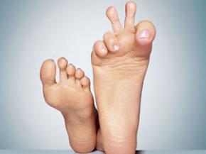 Потіння ніг, як позбавитися від неприємного запаху ніг, пітливості ніг.