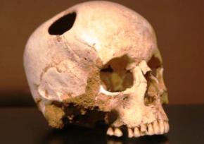 П'ять тисяч років тому люди вже вміли проводити операції з трепанації черепа
